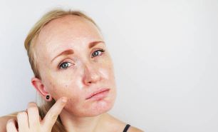 Home Remedies For Oily Skin That Work Well