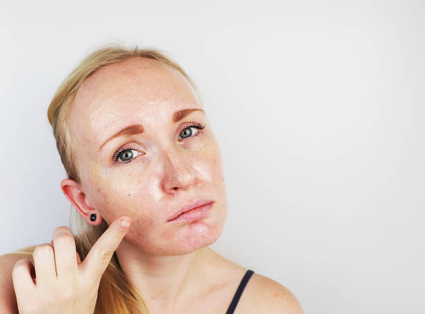 Home Remedies For Oily Skin That Work Well